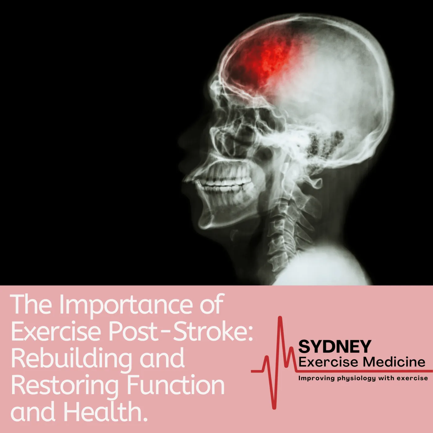 An X-ray graphic of a human skull with a highlighted brain area, with text reading "The Importance of Exercise Post-Stroke: Rebuilding and Restoring Function and Health".